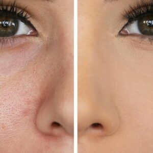 مسامات الوجه | كورس Skin Care