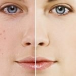 كيفية علاج التصبغات