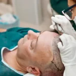 كورس زراعة الشعر