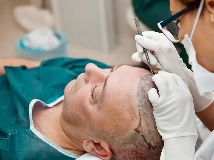 كورس زراعة الشعر