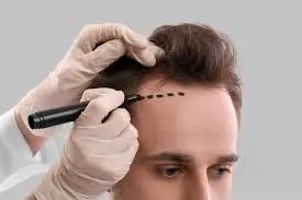 Hair transplant course